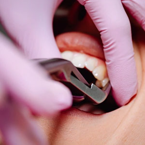 What to Expect After an Oral Surgery?
