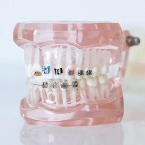 A Complete Guide: Choosing Braces in San Bernardino