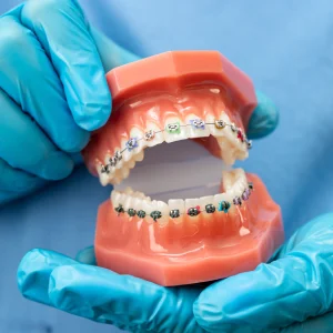 Benefits of Getting Braces in San Bernardino for Your Smile