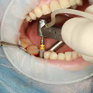 Oral Surgeon for Affixing Dental Implants | San Bernardino