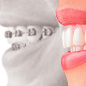 Orthodontic Choices: Braces vs. Clear Aligners