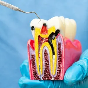 Top 6 Benefits of Root Canal Treatment in San Bernardino
