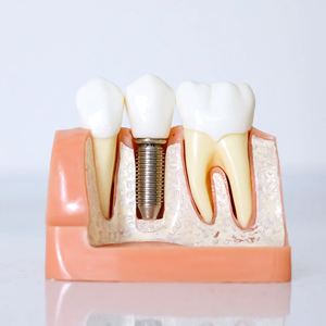 Visit an Oral Surgeon for Dental Implants? | San Bernardino