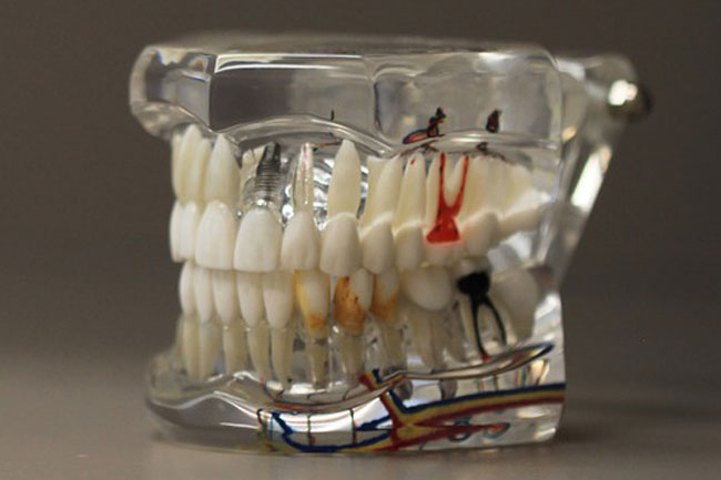 Why is a Root Canal Considered Oral Surgery? | San Bernardino Why is a Root Canal Considered Oral Surgery?