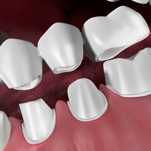Dental Bridges San Bernardino California