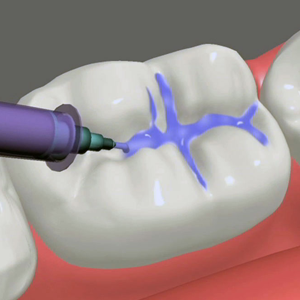 Tooth Colored Fillings San Bernardino California