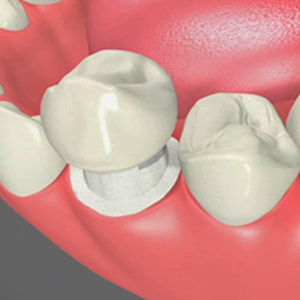 Dental Crowns San Bernardino California