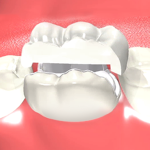 Dental Onlays San Bernardino California