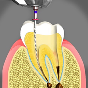 Root Canal Treatment San Bernardino California
