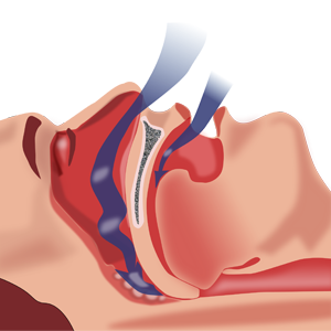 Sleep Apnea San Bernardino California