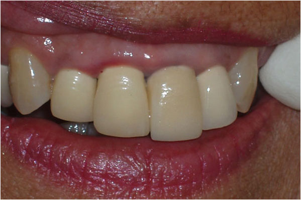 Dental Crowns and Bridges Before