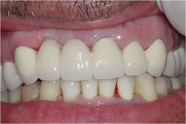 Dental Crowns and Bridges After