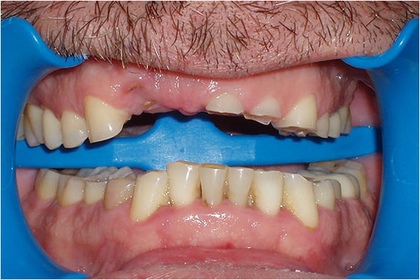 Dental Crowns and Bridges Before