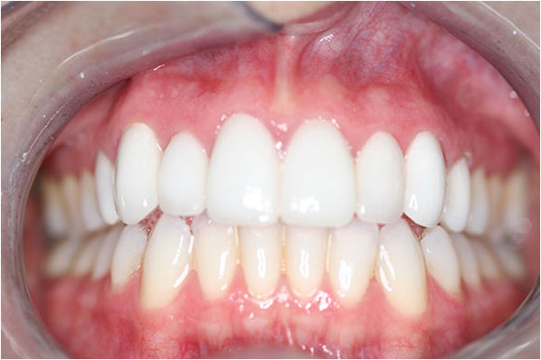 Dental Crowns and Bridges After