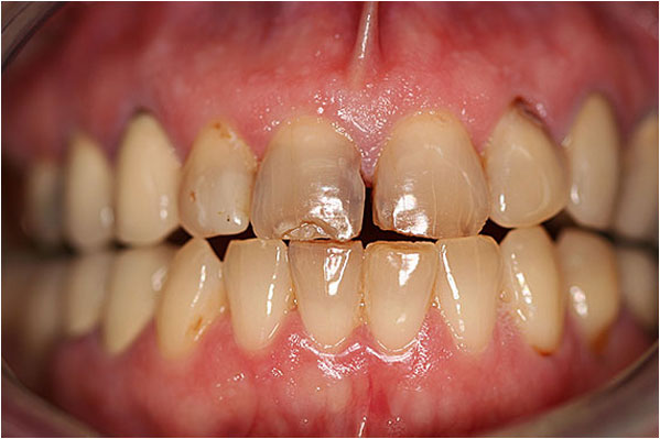 Dental Crowns and Bridges Before