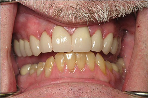 Dental Crowns and Bridges After