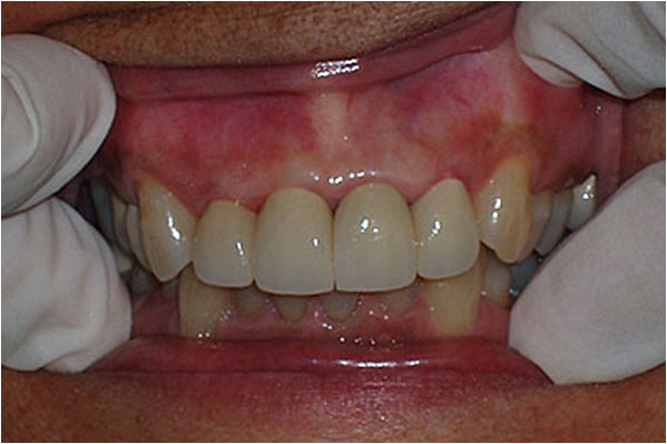 Dental Crowns and Bridges After