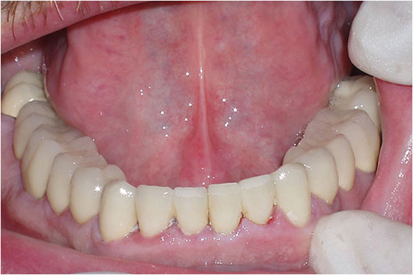 Dental Crowns and Bridges After