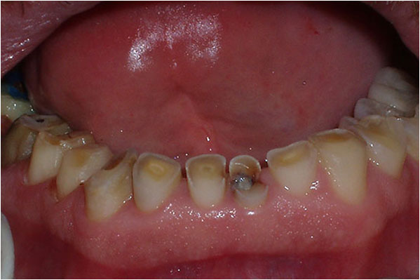 Dental Crowns and Bridges Before