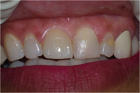 Dental Crowns and Bridges After