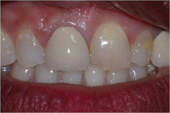 Dental Crowns and Bridges Before