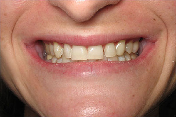 Dental Fills Before