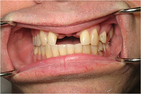 Dental Implants Before