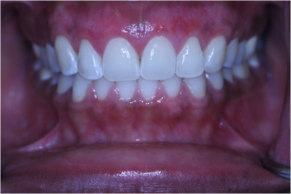 Laser Gum Bleaching After