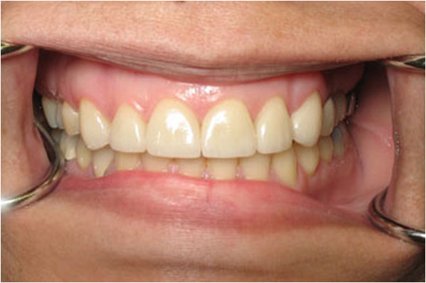 Veneers After