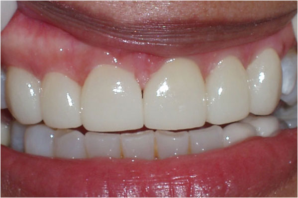 Veneers After